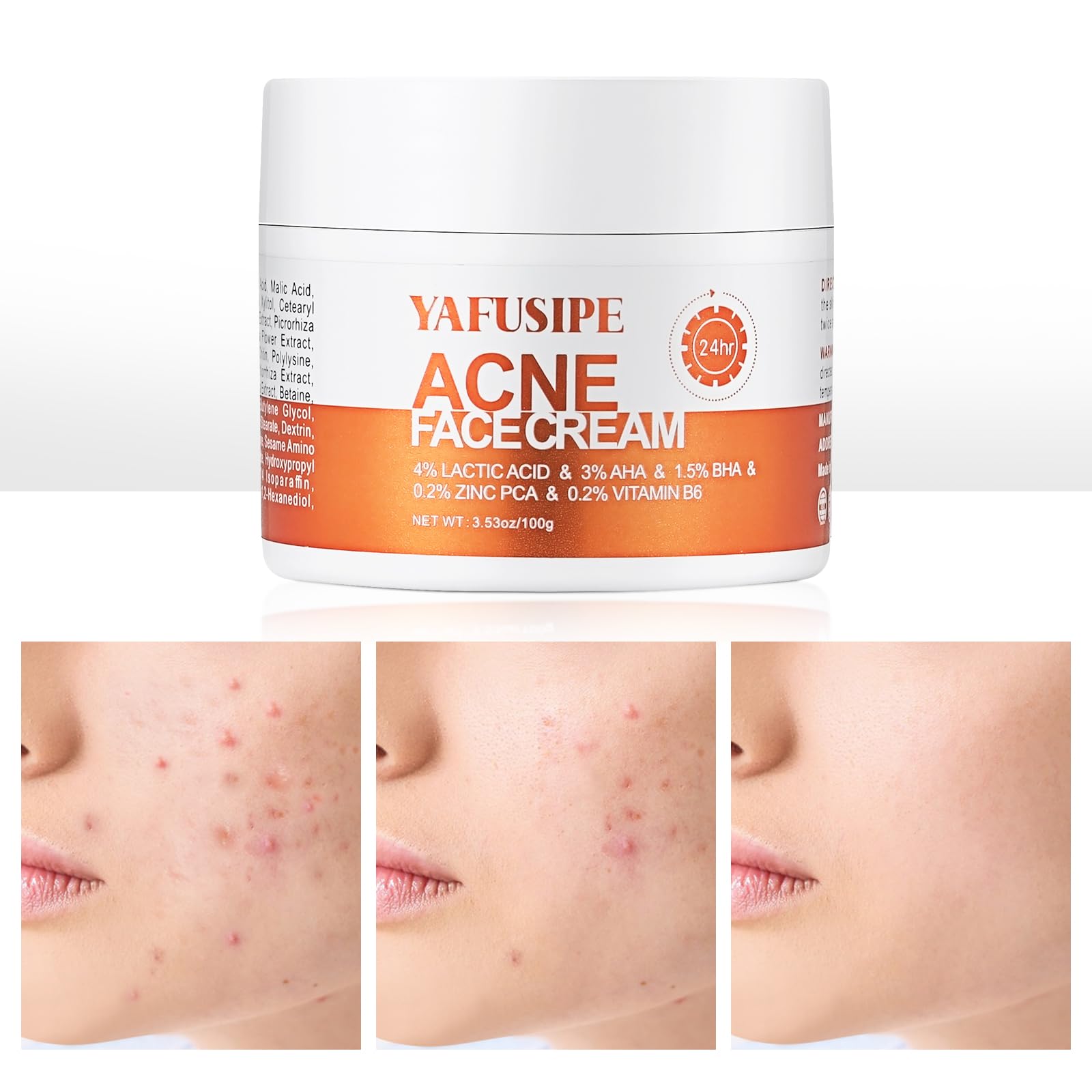 YAFUSIPE Acne Treatment bottle for gentle facial care and clearer skin.