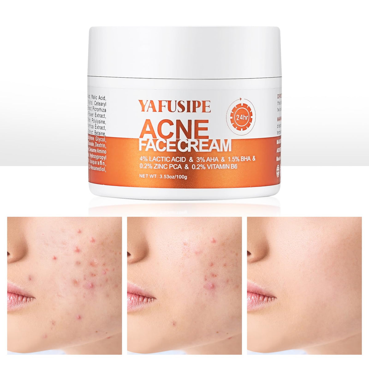 YAFUSIPE Acne Treatment bottle for gentle facial care and clearer skin.