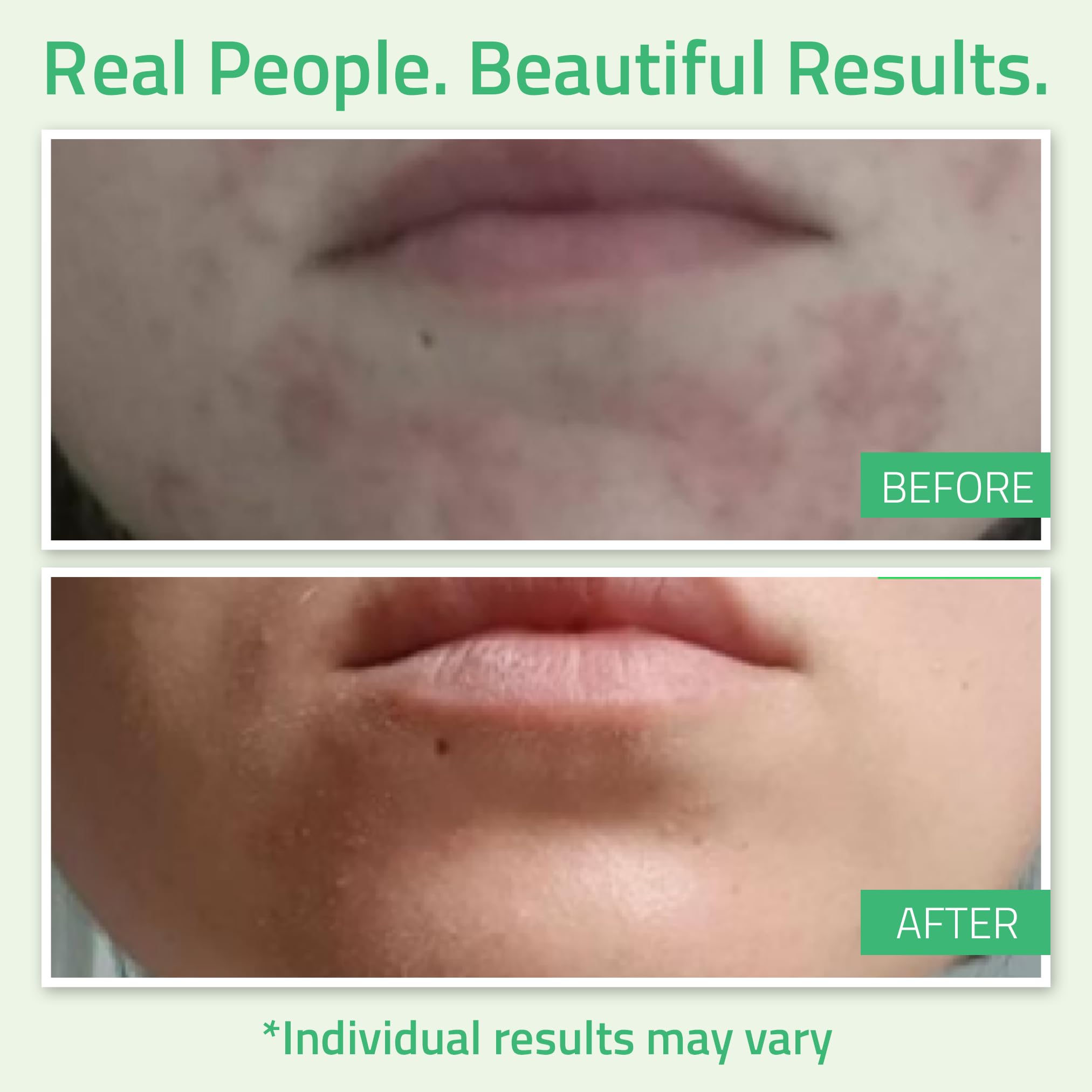 YEOUTH glycolic peel applied to skin to refine texture.