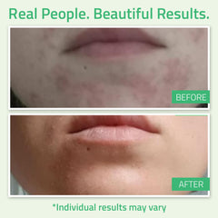 YEOUTH glycolic peel applied to skin to refine texture.