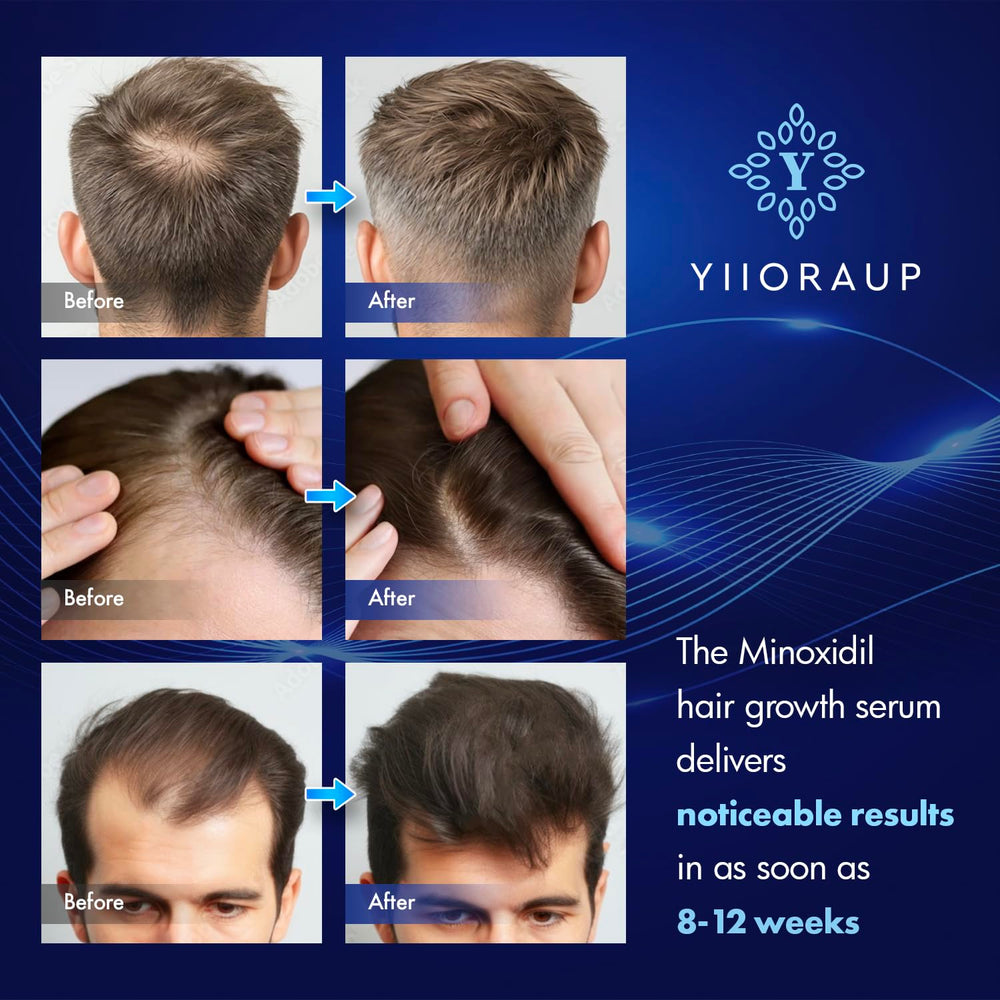 YIIORAUP Minoxidil 5% with biotin for daily scalp care and nourishment