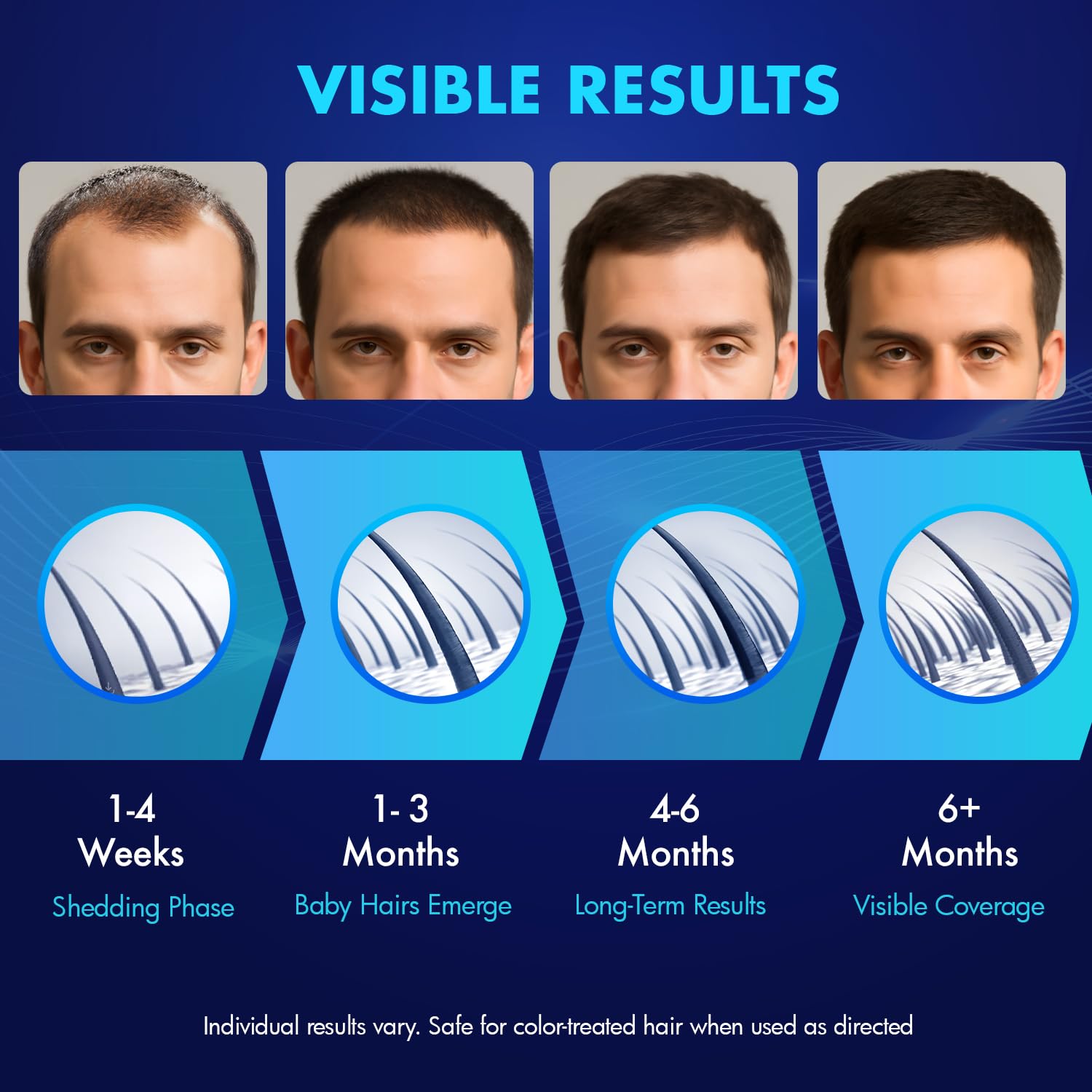 YIIORAUP Minoxidil 5% for both men and women in a simple daily routine