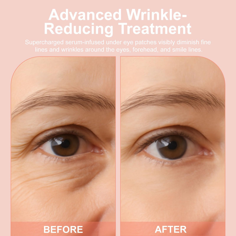 YLOTRE Novalift forehead and smile-lines patches for targeted refresh