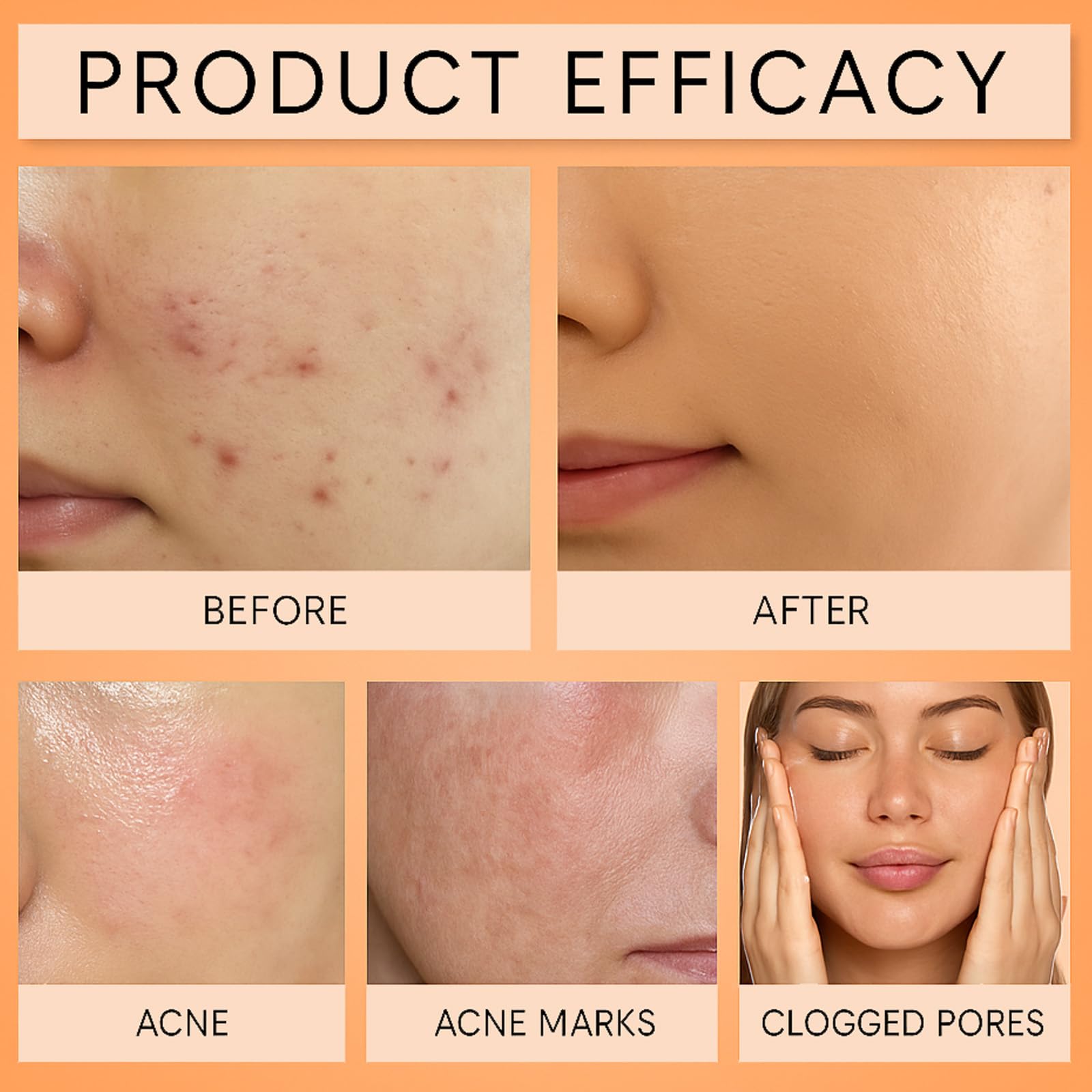 YOCMIPS Organics Acne Balm Set displayed as complete 4-in-1 daily skincare