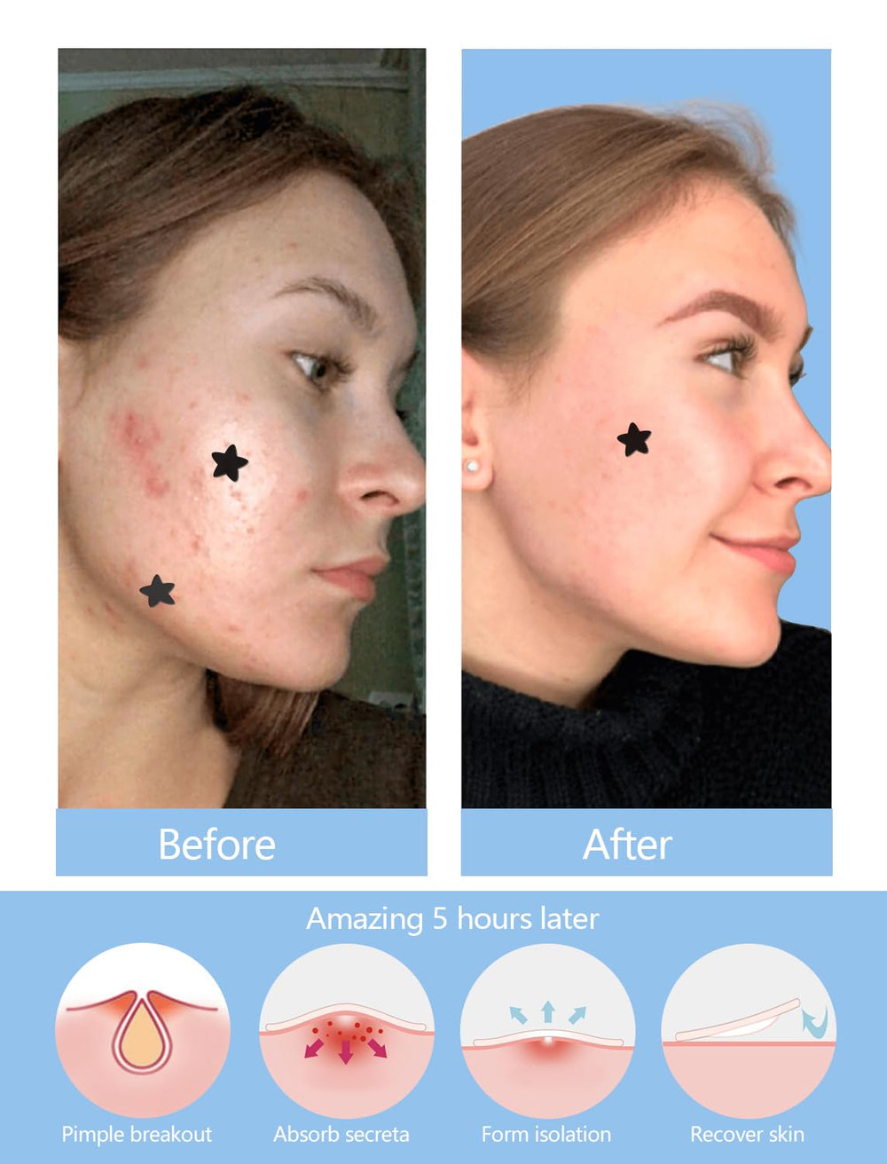 ZHAOLIESM salicylic acid ingredient helps clarify pores.