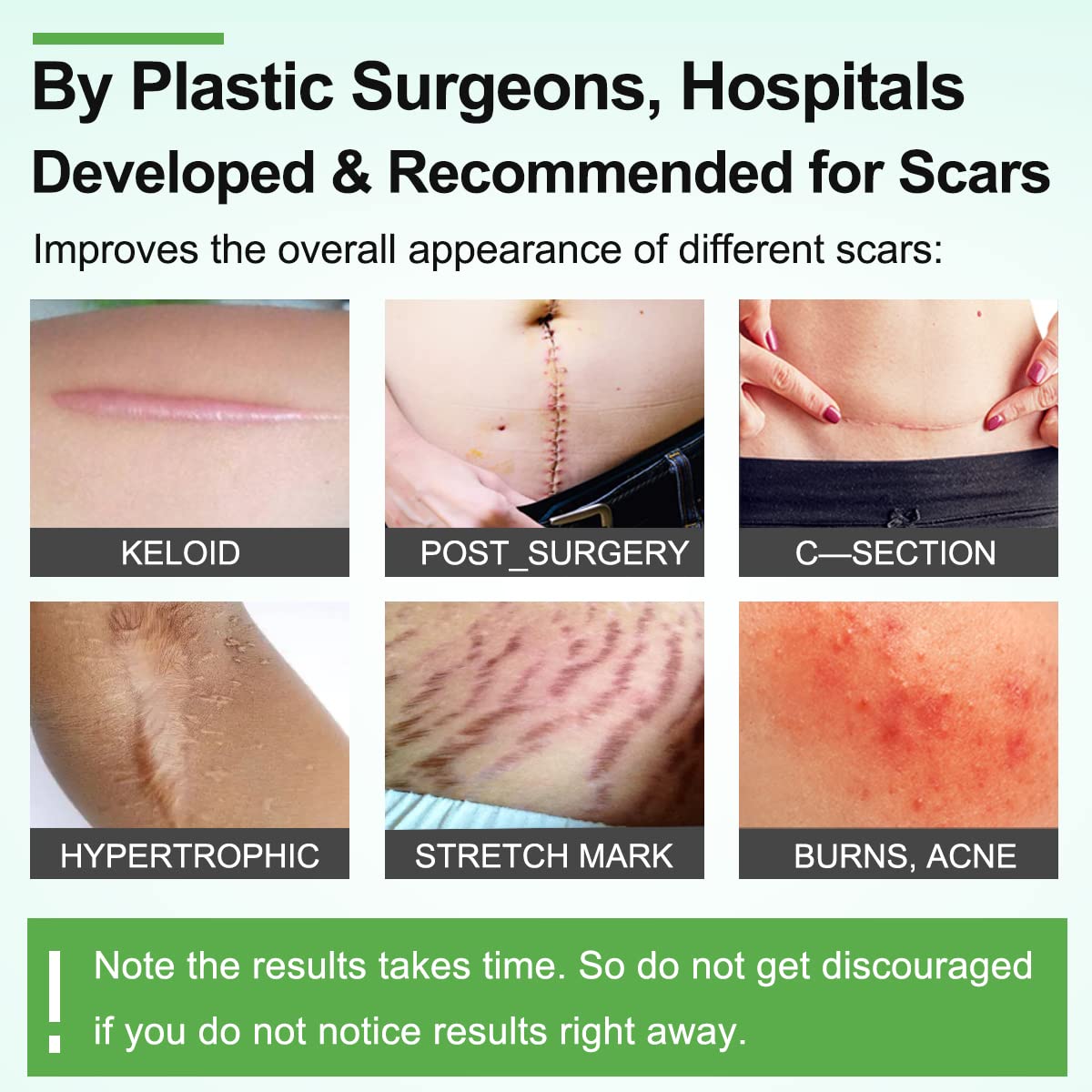 ZODENIS scar tape worn on skin, soft and flexible for daily wear.