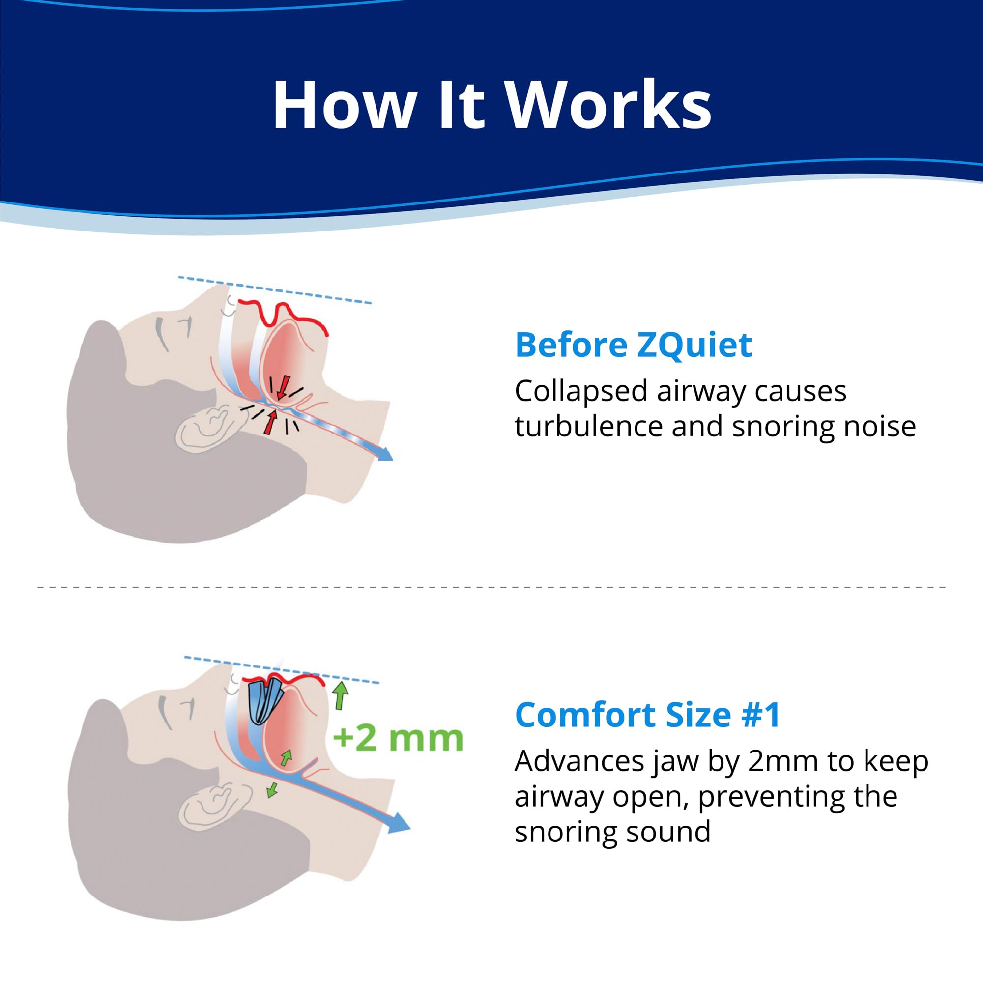 ZQuiet mouthpiece on teeth showing night-time fit