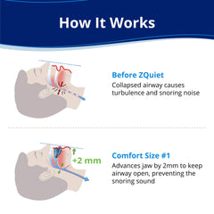 ZQuiet mouthpiece on teeth showing night-time fit
