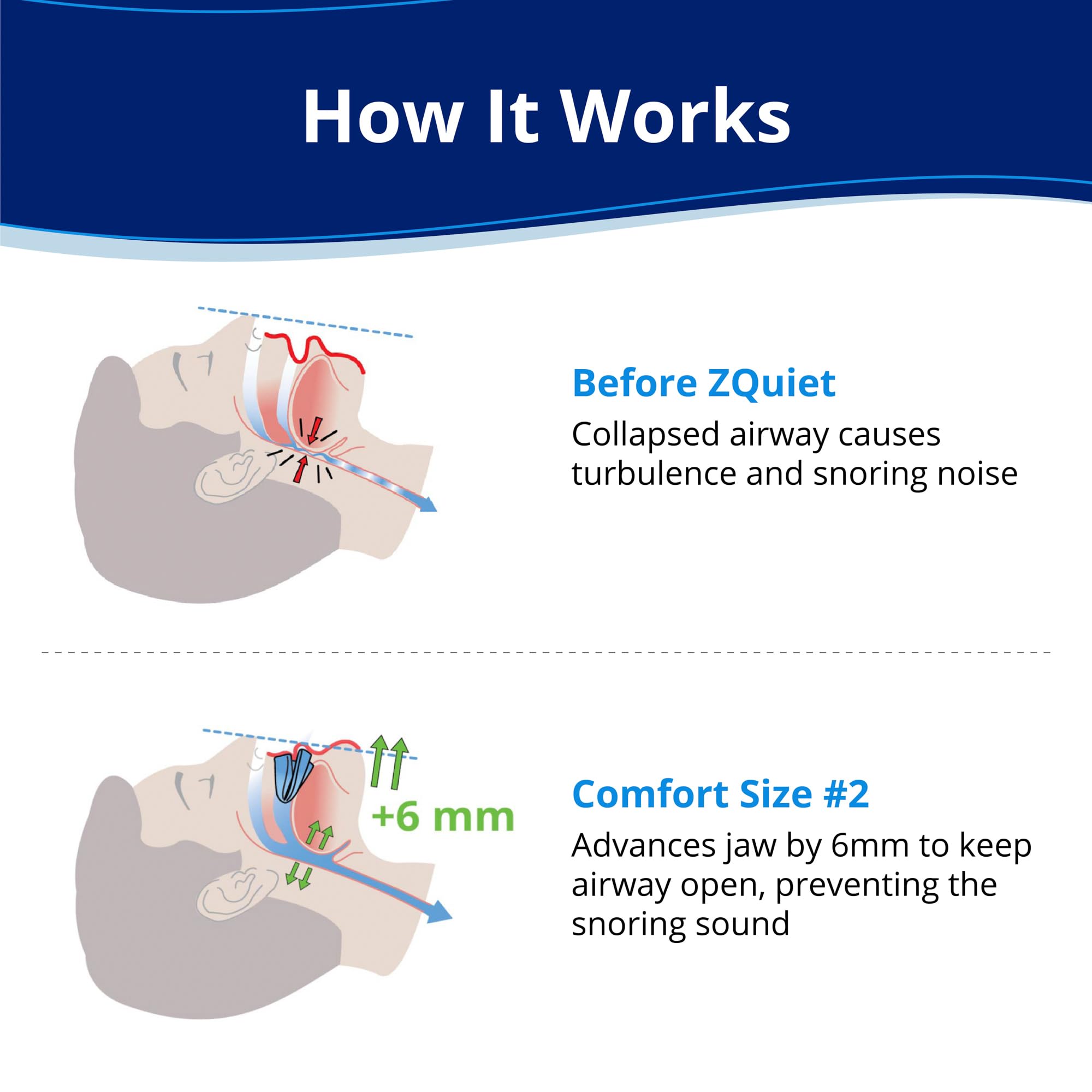 Close-up of ZQuiet Size #2 mouthpiece for precise fit